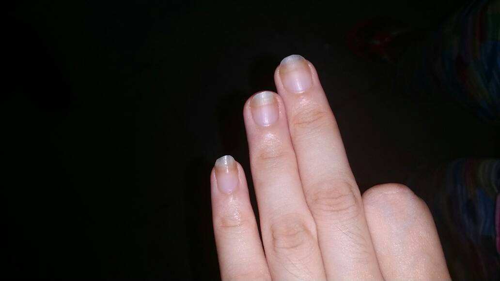 梦见拔手指上的肉刺是什么意思