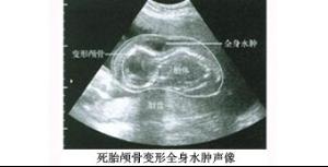 梦见自己怀孕死胎是什么意思