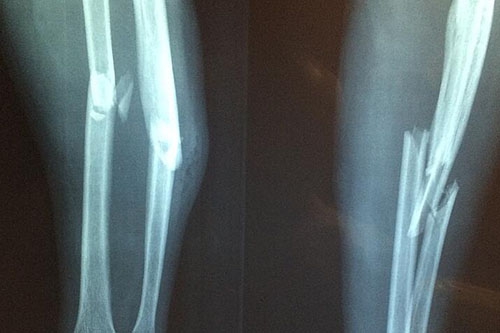 梦见自己是小腿断了是什么意思